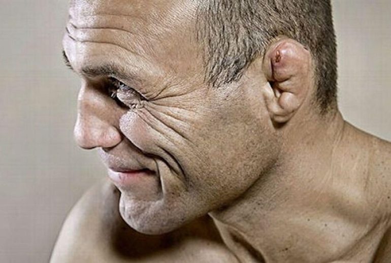 دکتر درمان هماتوم لاله گوش یا گوش گل کلمی - تبریز