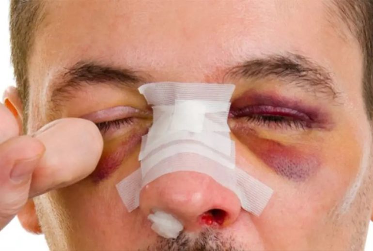 دکتر شکستگی بینی - مشهد