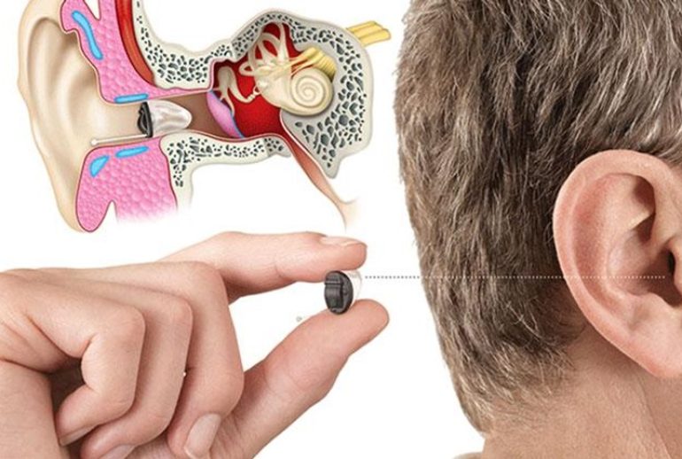 دکتر کاشت ساقه مغز شنوایی (ABI) - تهران